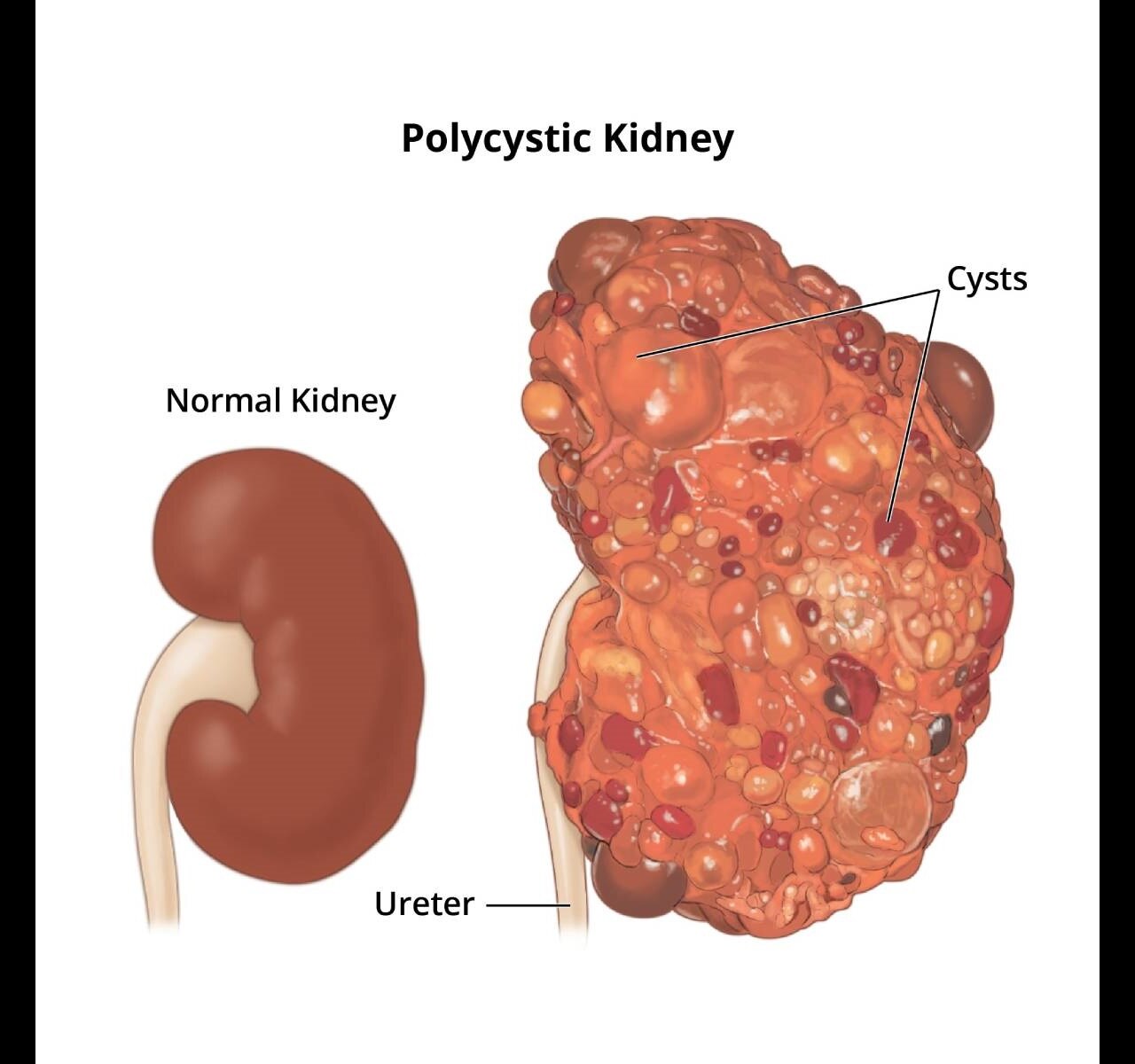 An illustration of a normal kidney and a polycystic kidney.