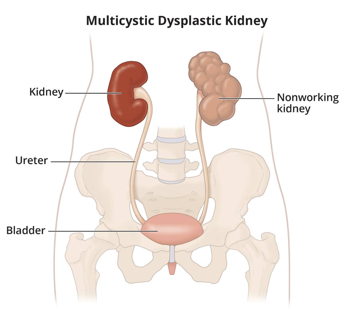 A urinary tract showing a multicystic dysplastic kidney, labeled as a nonworking kidney. The working kidney, ureter, and bladder are also labeled.