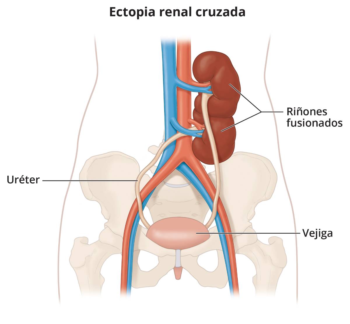 Un riñón ectópico fusionado, mostrando la pelvis, la vejiga, los uréteres y los riñones unidos. El riñón que normalmente estaría a la izquierda cruzó al otro lado del cuerpo y se fusionó con el riñón de la derecha.