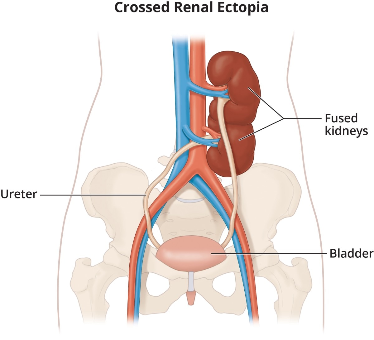 Crossed renal ectopia, which is two kidneys fused together on one side of the body.