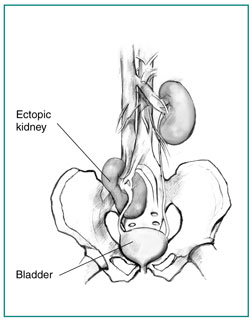 Drawing of a pelvic ectopic kidney, showing the pelvis, bladder, ureters, and kidneys. The kidney on the right is in the normal position, several inches above the bladder. The kidney on the left is an ectopic kidney, just a couple of inches above the bladder.