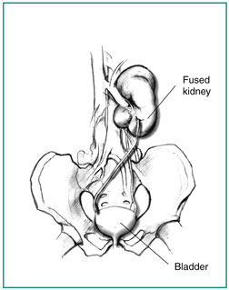 Drawing of a fused ectopic kidney, showing the pelvis, bladder, ureters, and fused kidneys. The kidney that would normally be on the left has crossed over and fused with the kidney on the right.