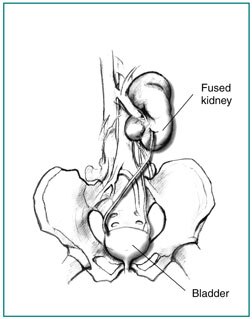 Drawing of a fused ectopic kidney, showing the pelvis, bladder, ureters, and fused kidneys. The kidney that would normally be on the left has crossed over and fused with the kidney on the right.