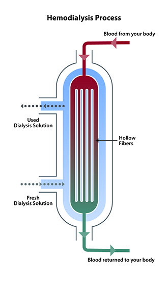 Diagram of blood flow from the top of the dialyzer to the bottom. Dialysis solution flows in the opposite direction, from bottom to top. Cross-section shows hollow fibers inside the dialyzer, where wastes pass from the blood into the solution.