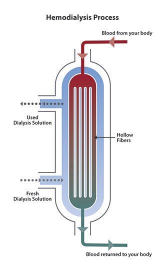 What Is The Process Of Haemodialysis