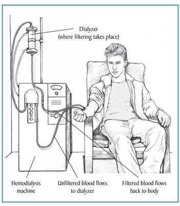 Picture of a teenage boy receiving hemodialysis treatment. Labels point to the dialyzer, where filtering takes place; hemodialysis machine; a tube where unfiltered blood flows to the dialyzer; and a tube where filtered blood flows back to the patient.