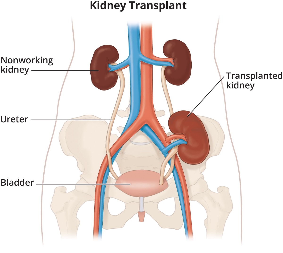 A kidney transplant showing the nonworking kidney, the working kidney, and the transplanted kidney in the pelvis.