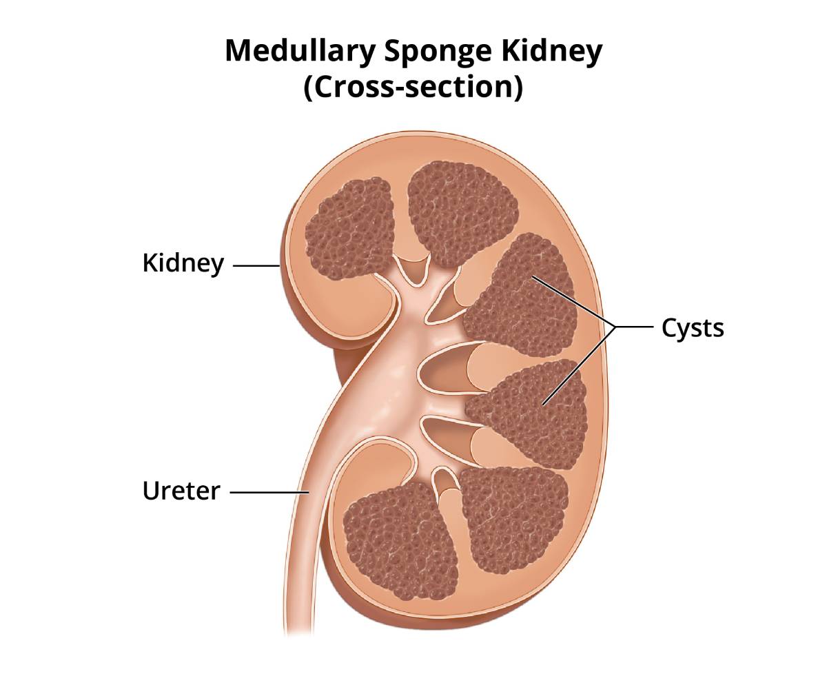 Kidney Pain: Causes, Treatment & When To Call A Doctor