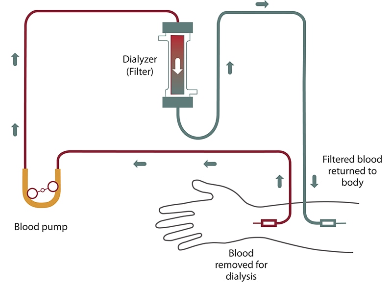 رسم تخطيطي لتدفق الدم لغسيل الكلى من ذراعك إلى أنبوب ومر بمضخة الدم إلى المرشح. يتدفق الدم المصفى مرة أخرى إلى ذراعك.
