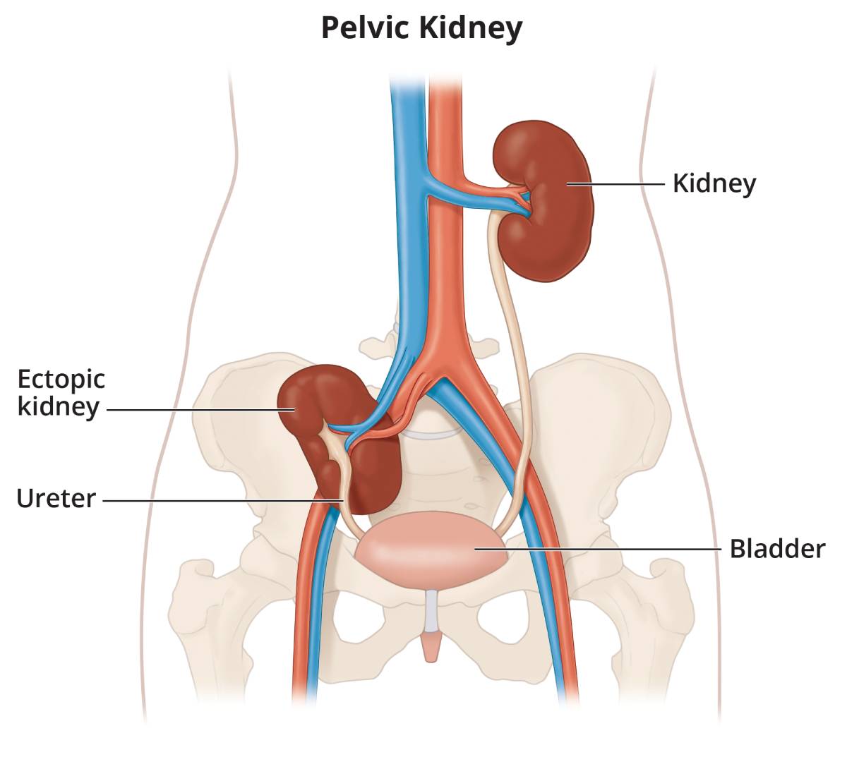 Pelvic kidney, which is a kidney that formed in the pelvis near the bladder.
