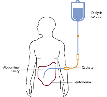Hemodialysis Diagram Hemodialysis Diagram