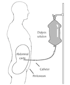 Patient receiving continuous ambulatory peritoneal dialysis (CAPD).