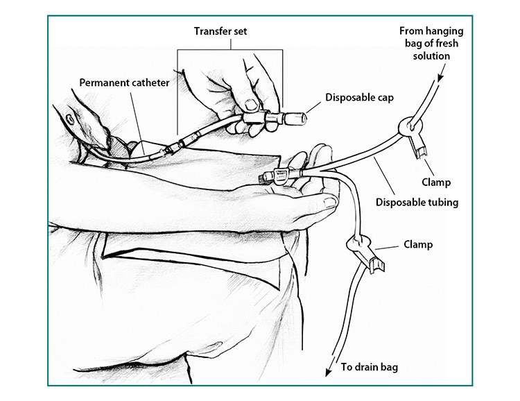 Close-up drawing of a transfer set. The permanent catheter connects to the transfer set, which has a disposable cap. Y-shaped disposable tubing has one branch coming from a hanging bag of fresh solution and one branch going to a drain bag. Both branches have clamps.