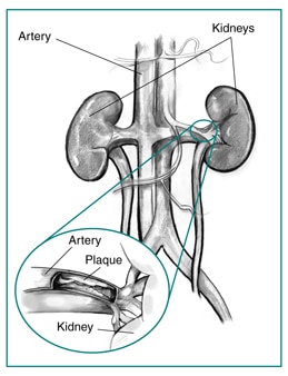 Drawing of the kidneys with an insert showing a magnified cross-section of the renal artery with plaque building up on the inner wall.