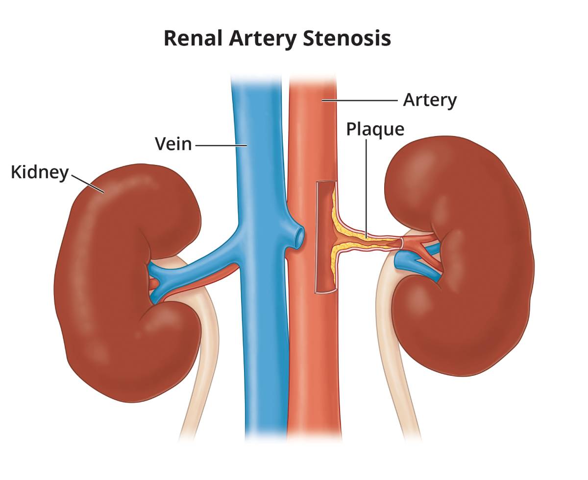 Renal artery stenosis, which is plaque buildup in the artery that leads to the kidney.