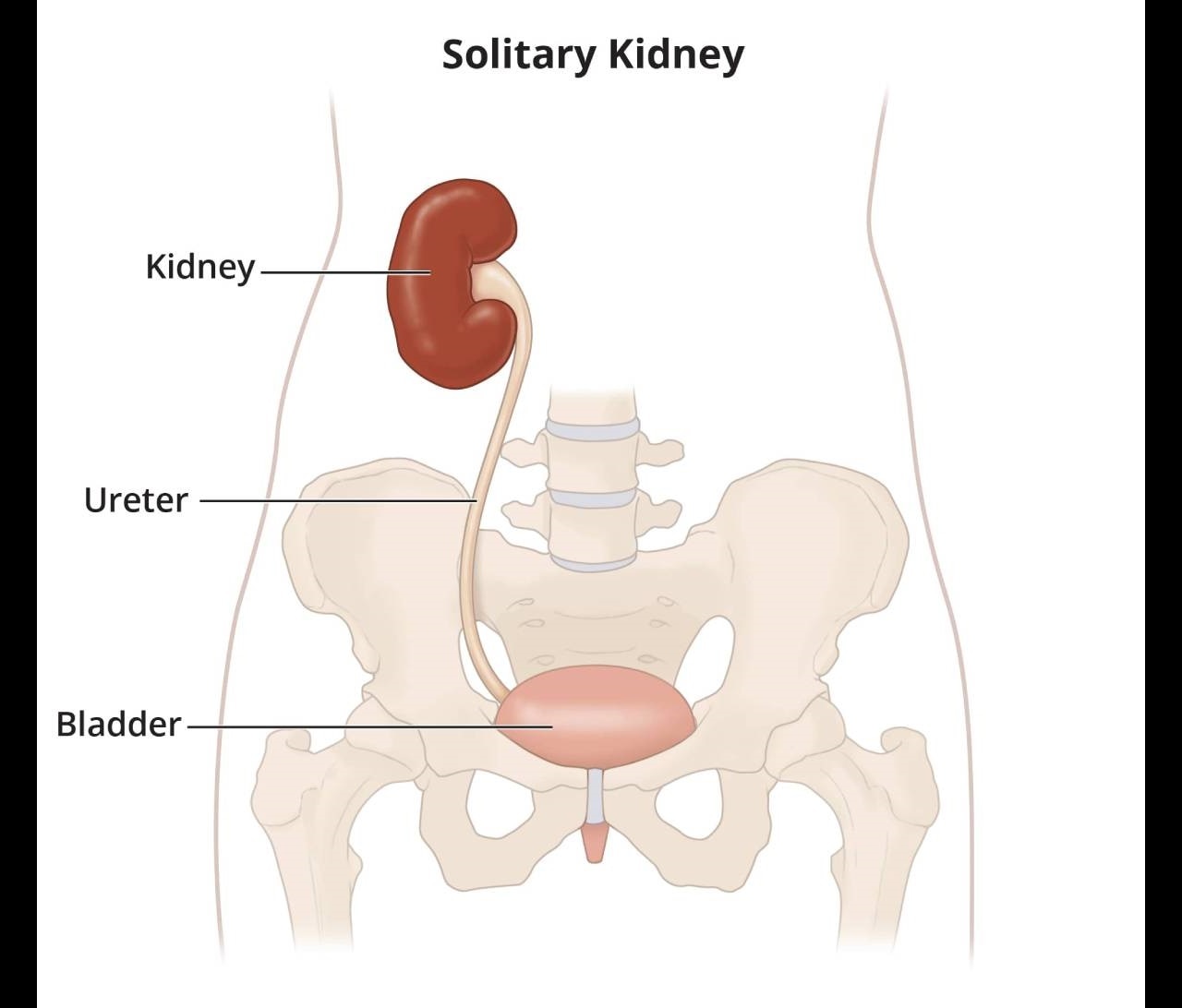 The illustration shows a solitary kidney, one ureter, and the bladder.