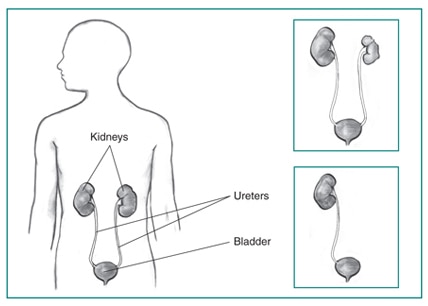 The urinary tract consists of two kidneys, two ureters, and the bladder. The top right inset illustration shows a healthy kidney, a nonworking kidney, two ureters, and the bladder. The bottom right inset illustration shows a solitary kidney, one ureter, and the bladder.