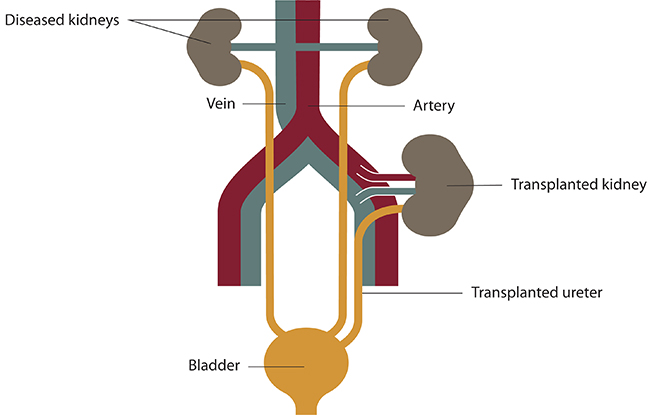 Drawing of the transplanted kidney and ureter in relation to the urinary tract and blood supply.