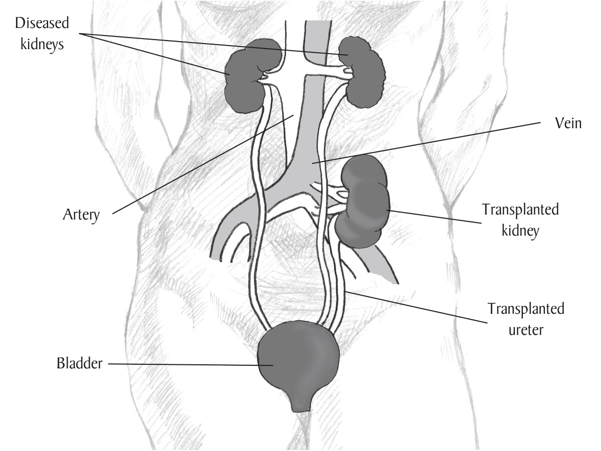Diagrama de um rim transplantado.