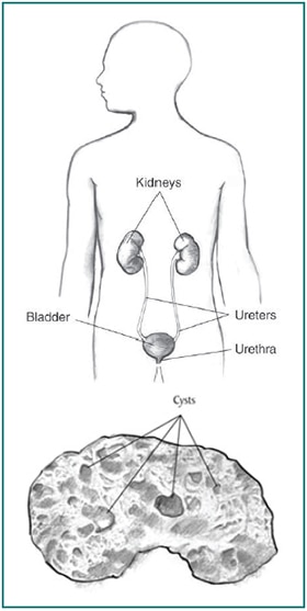 Drawing of a male torso with kidneys, ureters, bladder, and urethra labeled, and a drawing below of a kidney with sacs of fluid labeled as 
