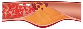 Illustration of a blood vessel with plaque and blood clot.
