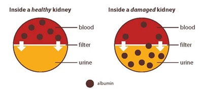 A diagram illustrating a healthy kidney with albumin only found in blood, and a damaged kidney that has albumin in both blood and urine.