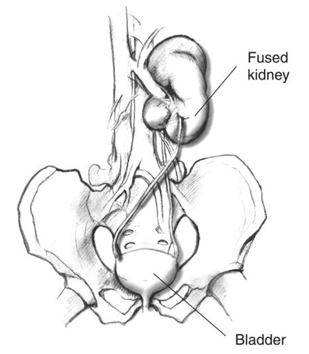 A fused ectopic kidney, showing the pelvis, bladder, ureters, and fused kidneys. The kidney that would normally be on the left has crossed over and fused with the kidney on the right.