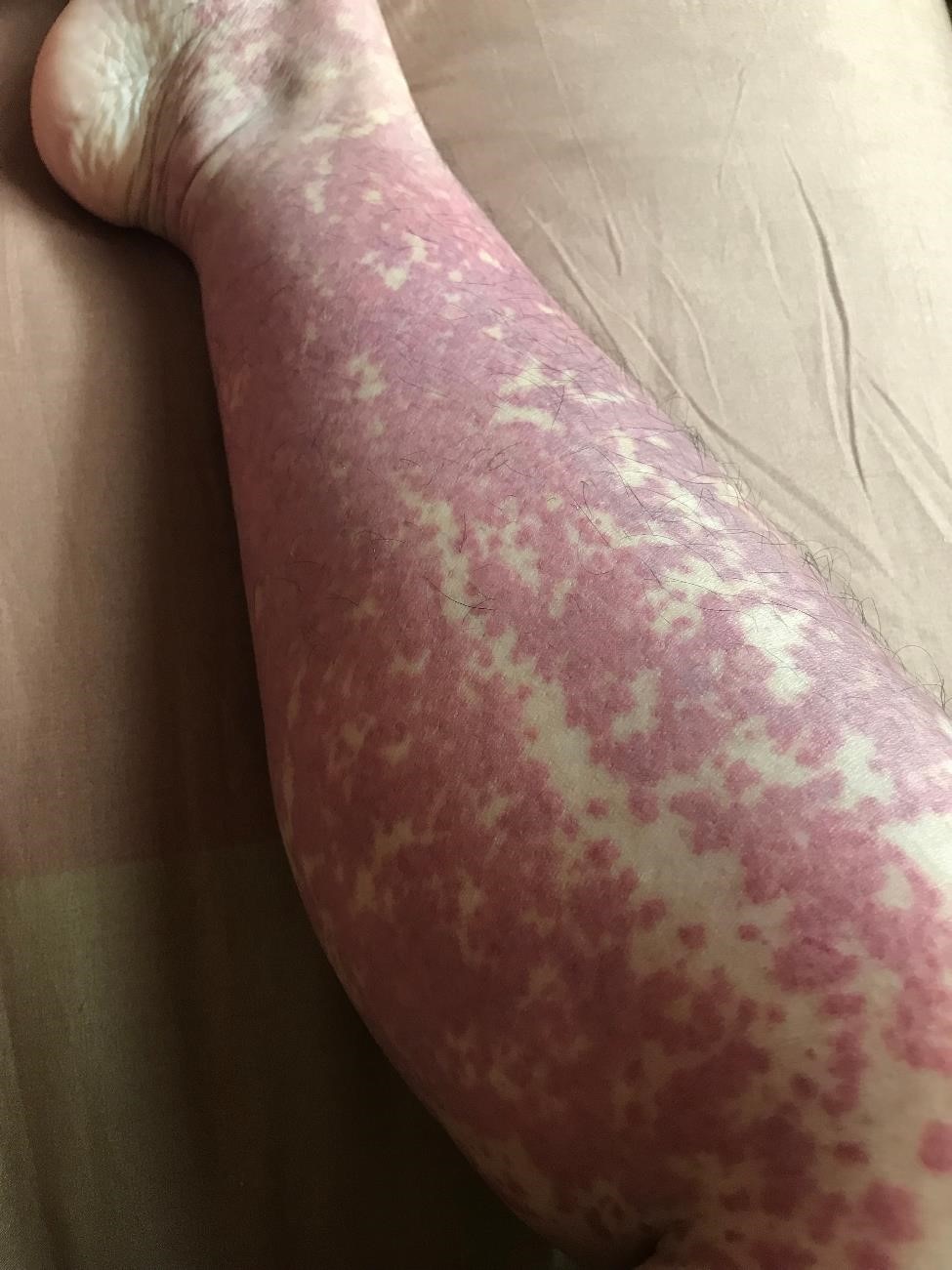 Lower leg nearly covered in a purple rash.