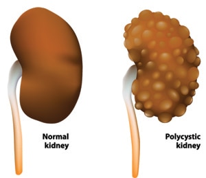 An illustration of a normal kidney and a polycystic kidney.
