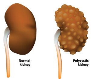 What Is Polycystic Kidney Disease? - NIDDK