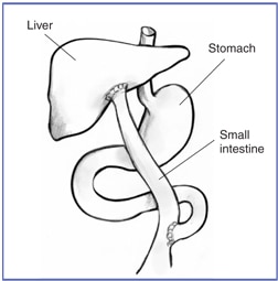 Diagram of the Kasai procedure with liver, stomach, and small intestine labeled.