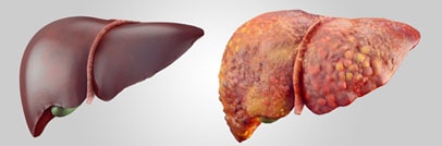 A healthy liver on the left and a diseased liver on the right.