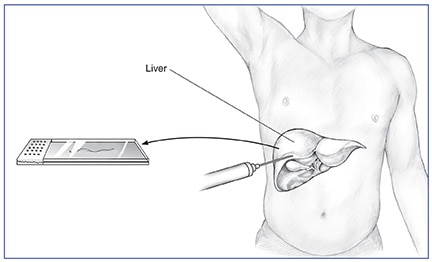 Drawing of a liver biopsy procedure, showing a liver within an outline of a male body, a needle pricking the liver tissue, and a slide with the tissue sample.