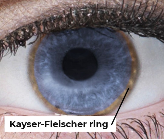 kayser fleischer ring