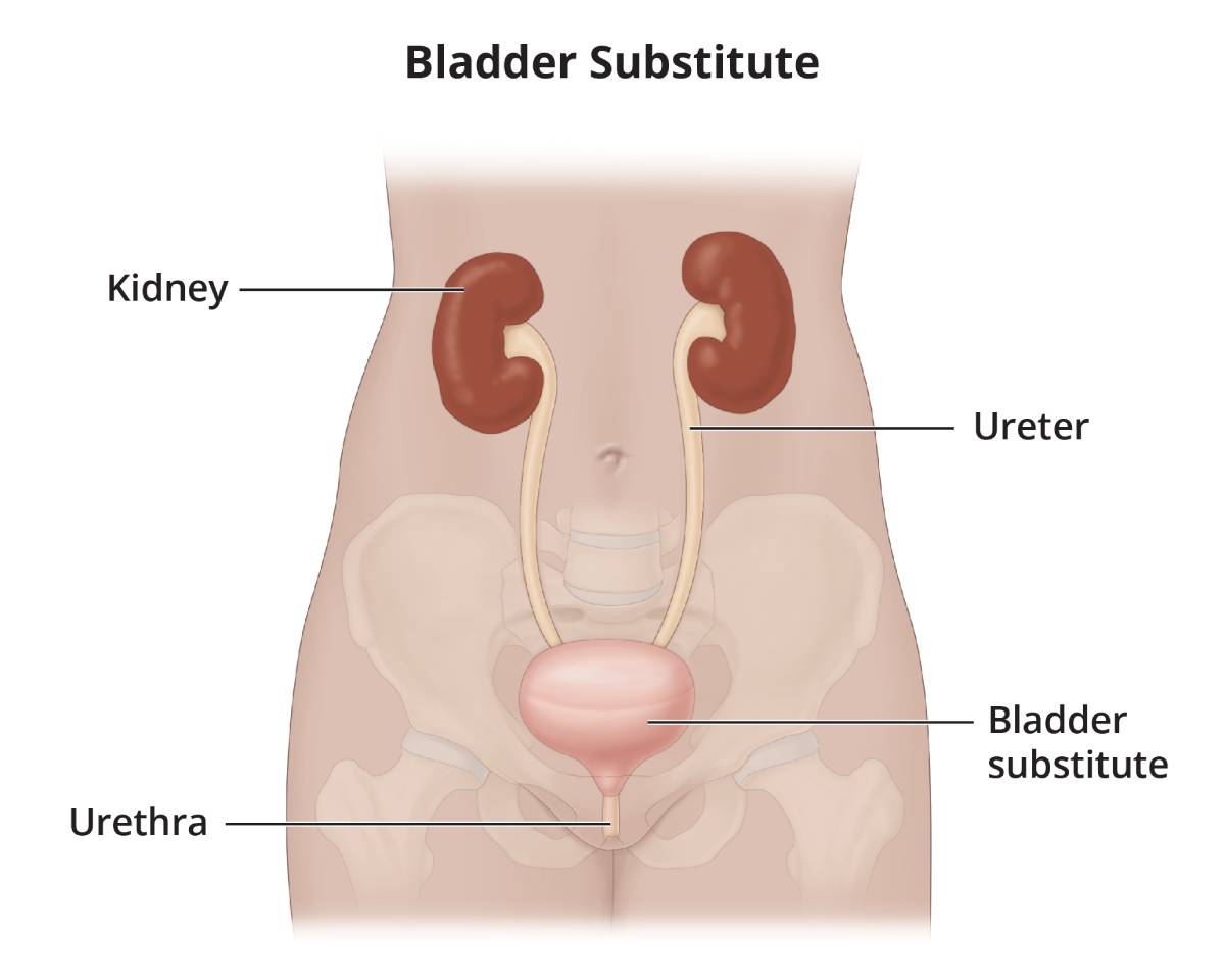 Urinary Diversion - NIDDK