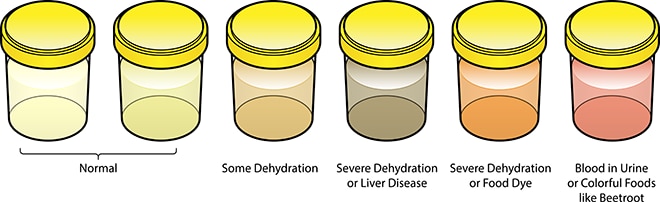 A series of urine samples. Light-colored urine is normal. Deep-yellow urine suggests dehydration. Dark brown or orange urine suggests severe dehydration or liver disease. Urine that is pink suggests blood in the urine or having eaten beets. Odd urine color may also be caused by eating foods with large amounts of dyes.