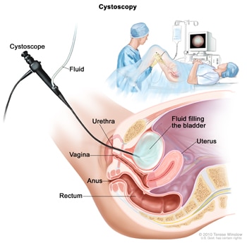 Illustration of cystoscopy. A cross-section shows the cystoscope inserted into the urethra. Fluid flows from a bag through the cystoscope to fill the bladder. The uterus, vagina, anus, and rectum are shown in the cross section.