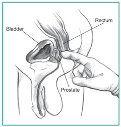 Cross-section of a digital rectal exam. A health care provider’s gloved index finger is inserted into the rectum to feel the size and shape of the prostate.