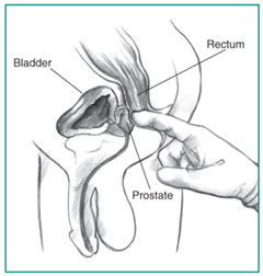 Cross-section of a digital rectal exam. A health care provider's gloved index finger is inserted into the rectum to feel the size and shape of the prostate.