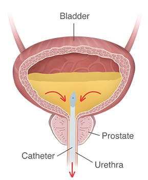 Une vessie remplie d'urine, et un cathéter inséré par l'urètre et dans la vessie, avec des flèches montrant l'écoulement de l'urine hors de la vessie par le cathéter.