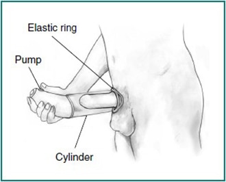 Krachtcel In detail Alvast Treatment for Erectile Dysfunction - NIDDK