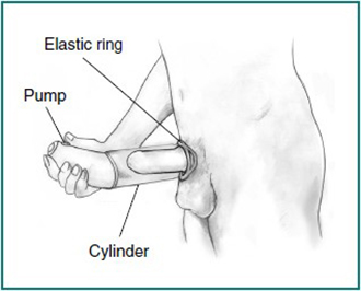 A black and white illustration of a man using a vacuum device on his penis. The device includes an elastic ring, a pump, and a cylinder. 