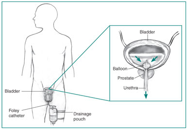 Outline of a male body showing the bladder, penis, drainage pouch strapped to one leg, and the inserted Foley catheter. Inset of the bladder, prostate, and urethra, showing urine flow from the bladder through the catheter.