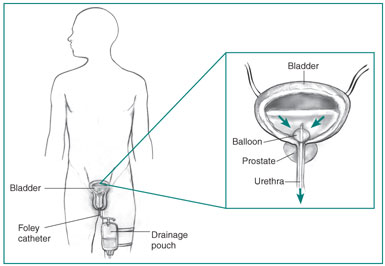 prostatitis catheterization)