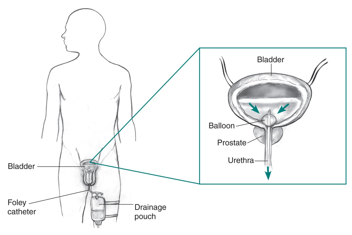 Outline of a male body showing a Foley catheter inserted into the bladder. A drainage pouch is attached to the thigh. An inset image shows a closer view of the flow of urine through the catheter and out the bladder. The catheter is held in place with a balloon.