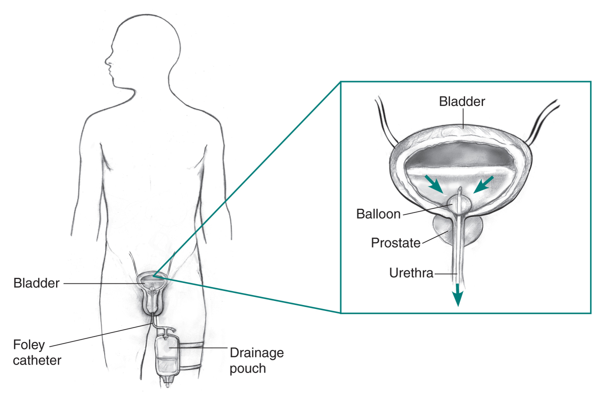 Enlarged Prostate (Benign Prostatic Hyperplasia) - NIDDK