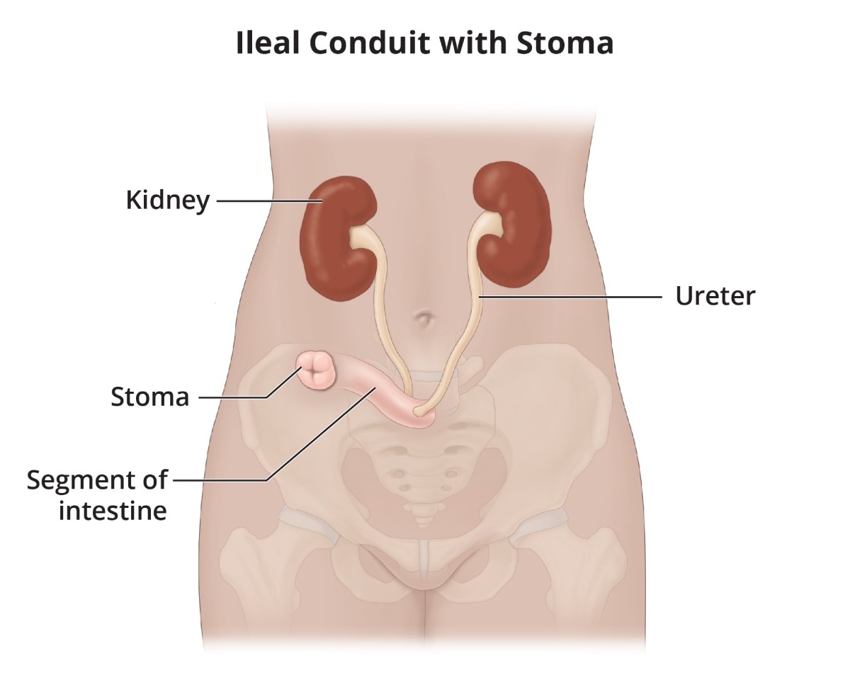 An ileal conduit with stoma shows the ureters attached to a stoma using a segment of intestine.