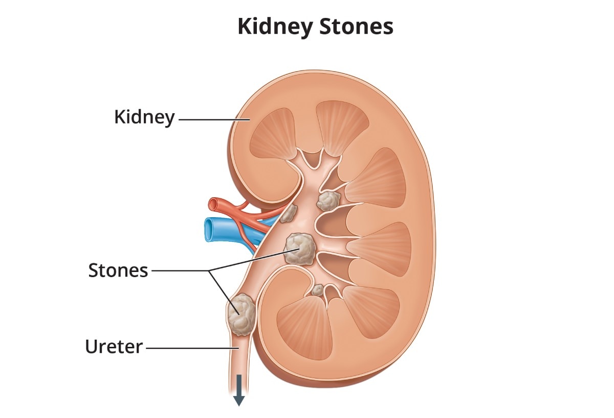 Kidney with several kidney stones, including one stone blocking the ureter. The kidney, the stones, and the ureter are labeled.