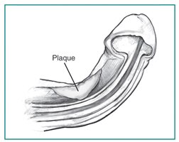 A cross section of a curved penis during an erection, showing the location of plaque.