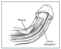 Secção cruzada de um pénis mostrando curvatura causada por uma placa durante a erecção.